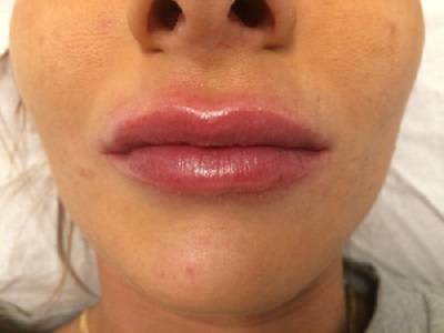 Female After Dermal Fillers (lip Borders)